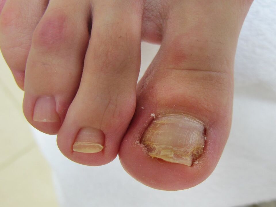 nail fungus symptoms