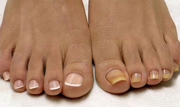 Healthy toenails (left) and those affected by the fungus (right)