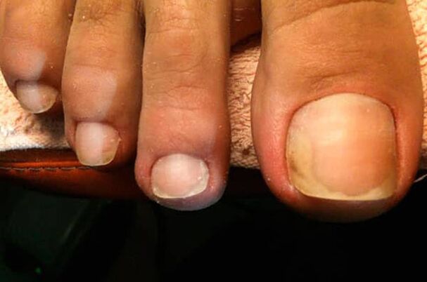 Nail fungus starts from the big toe
