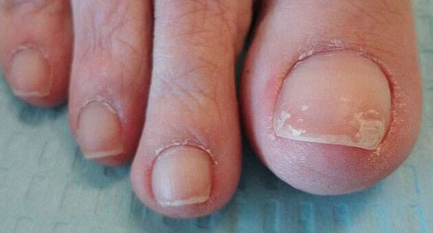 One of the symptoms of onychomycosis is the separation of the nail plate. 
