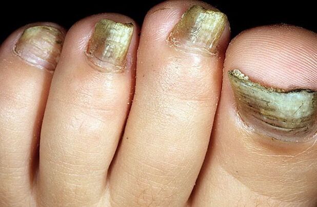 advanced stage of nail fungus