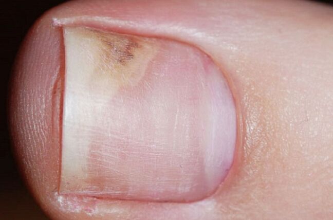 Symptoms of onychomycosis in the initial stage - lack of shine, gap between the nail and the bed
