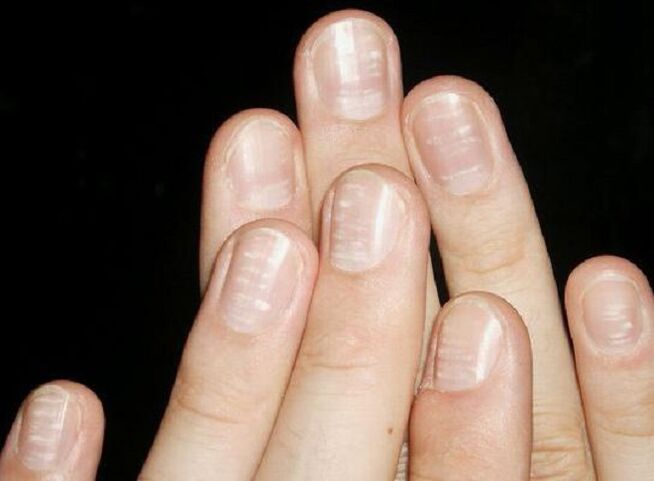 White spots on nails are a sign of fungal growth