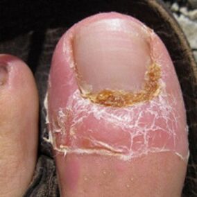 Nail trunk