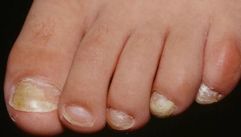 Nail mushrooms on thumb