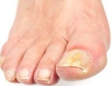 Easier to remove the nail affected after bath