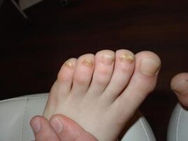 Nail fungi also happen in children