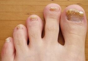 Onychomycosis sitting on