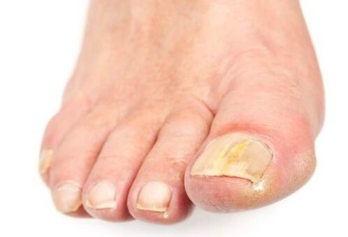 Mushrooms on the nail