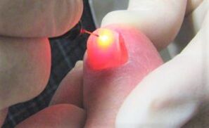 Treatment of nail fungus with a laser