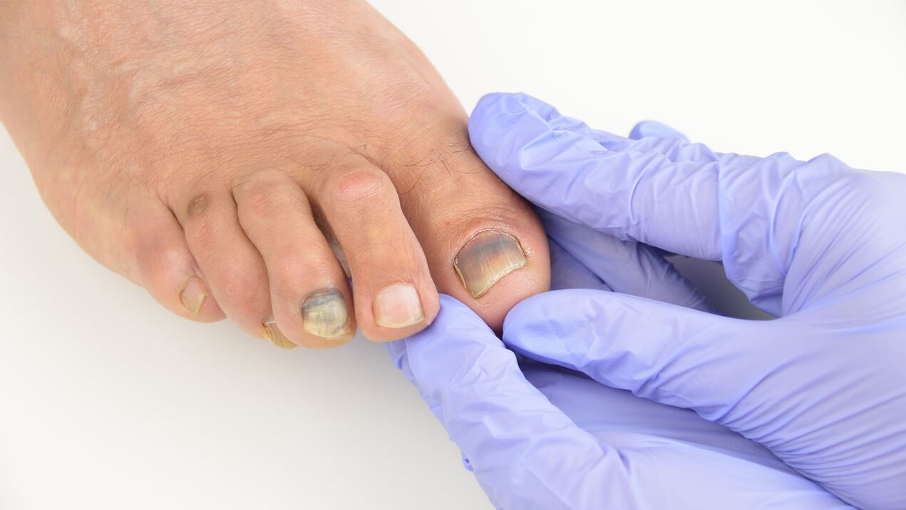 Checking the mushroom of the foot