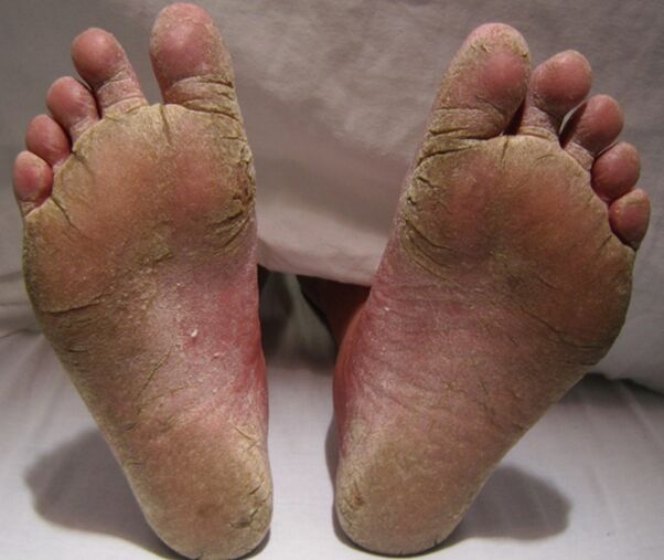 Myotic defeat of the feet