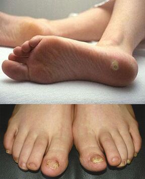 Mushrooms in the legs