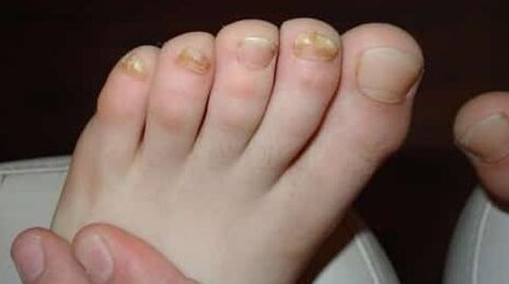 Almost all fingers are affected by mushrooms