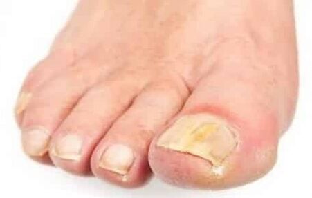 The initial stage of fungi in the foot of the foot