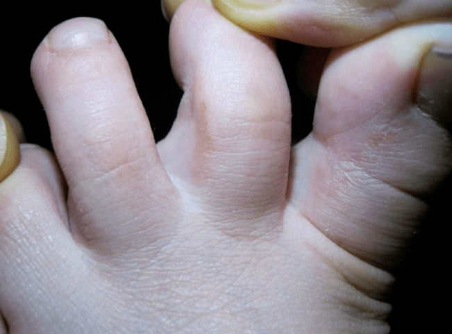 Mikosis in children