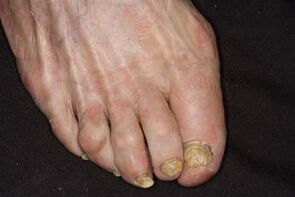 Treatment of nail fungi on the legs Apple Cider cider