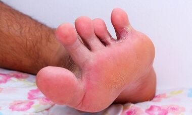 Reasons for the mushroom between toes