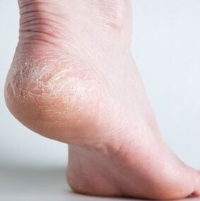 Diagnosis of nail fungus