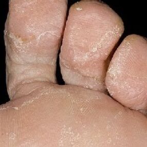 Stages of nail fungus