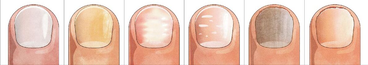 How nail fungus develops