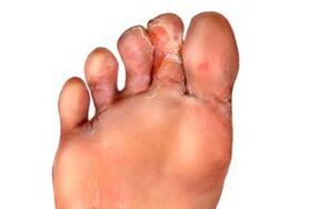 fungus between the fingers