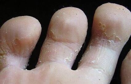 signs of fungus between the fingers