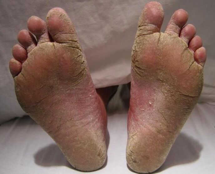 squamous-hyperkeratic fungus on the legs