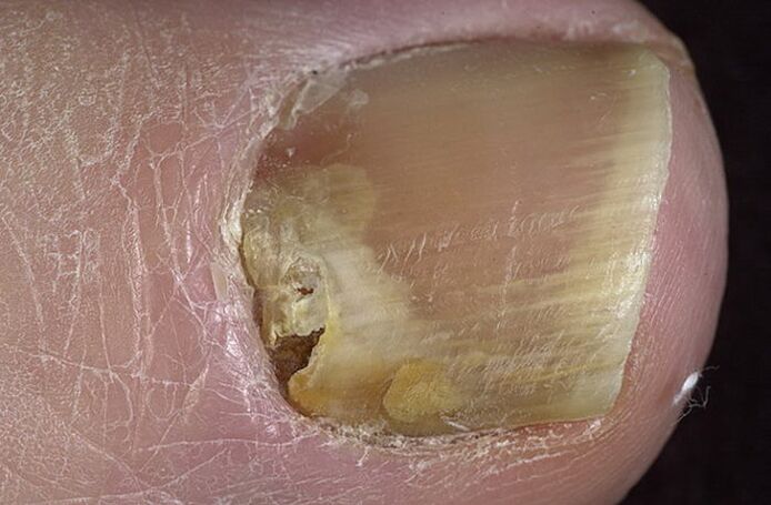toenail fungus
