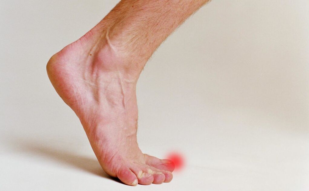 Nail fungus on the big toe