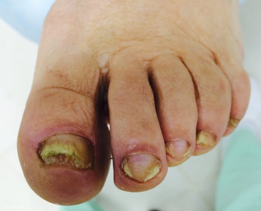 Severe deformation of the toenails is a sign of the third stage of development of the fungus