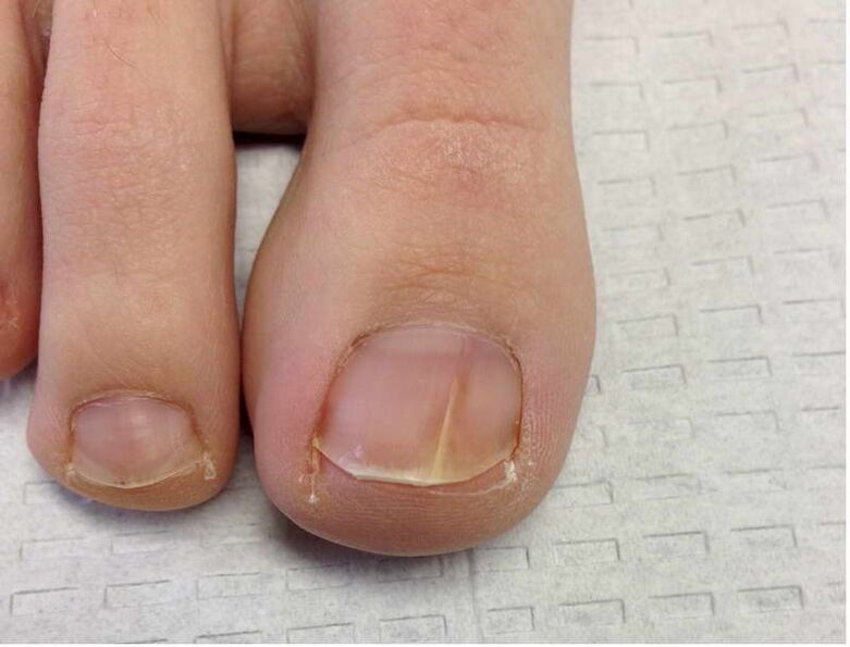 Stripes and spots on the nail of the thumb in the first stage of fungal development