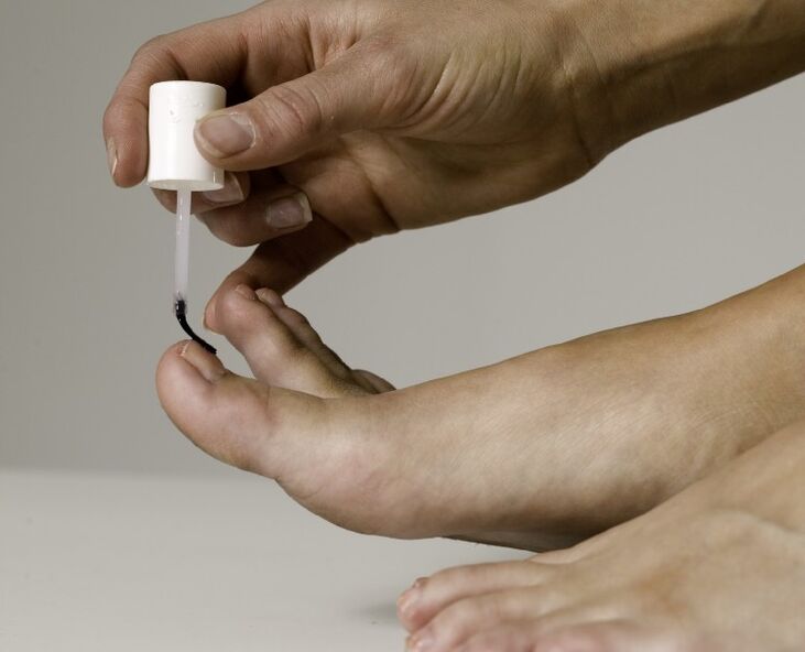 The use of medicated varnish for the treatment and prevention of onychomycosis in the big toe