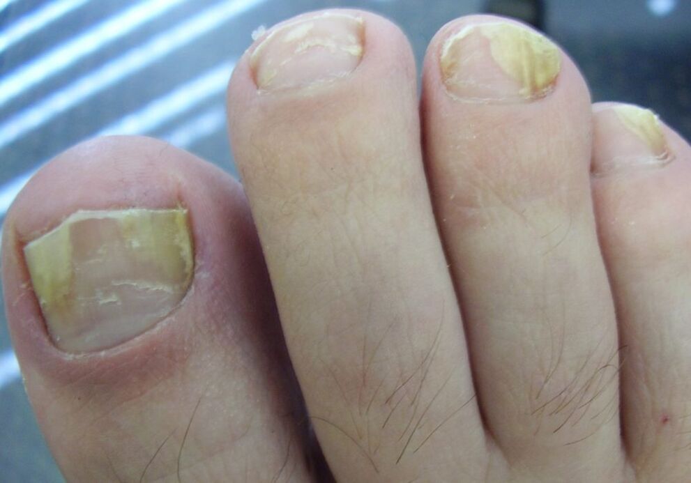 Yellow color of the nail plate in the second stage of fungal infection