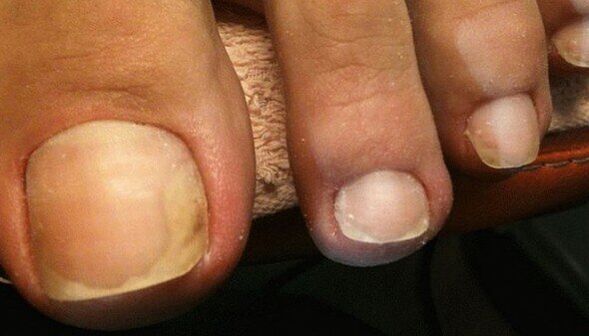Symptoms of the initial stage of nail fungus